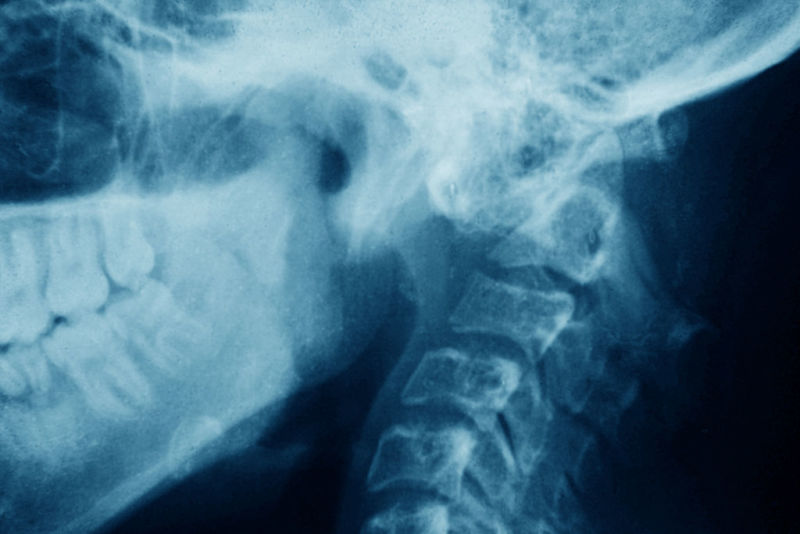 Dislocated cervical vertebrae (traumatic lesion of cervical vertebrae C1-C2). X-ray in profile. (Photo by: BSIP/Universal Images Group via Getty Images)