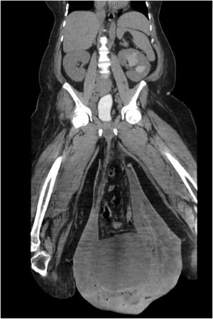  CT imaging illustrating impressive scrotal edema and massive inguinal hernia.