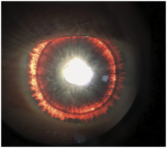 Pigment dispersion syndrome in a 44-year-old man.