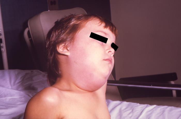 This image depicts a child with a mumps infection. Note the characteristic swollen neck region due to an enlargement of the boy’s salivary glands.