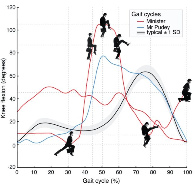 Comparison of two full gait cycles from the minister, one from Mr. Putey, and the mean curve for people without pathology.