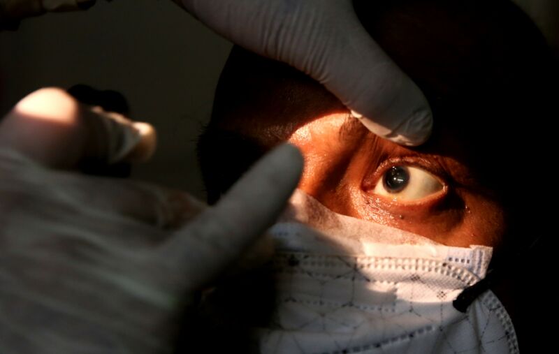 A suspected mucormycosis black fungus patient receives examination at a hospital in Bhopal, India, on May 29, 2021. 