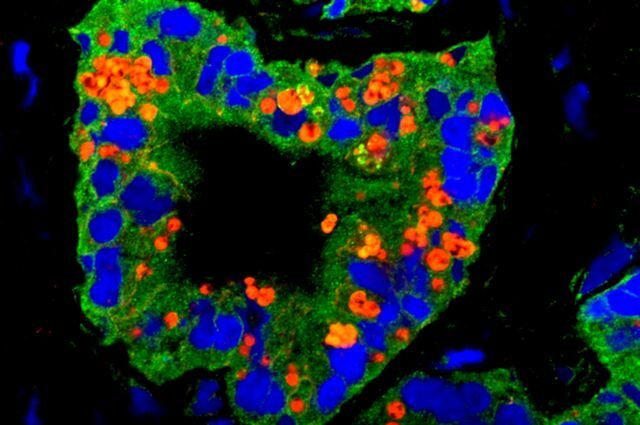 A prostate tumor, with green and red labels identifying the presence of proteins in stem cells.