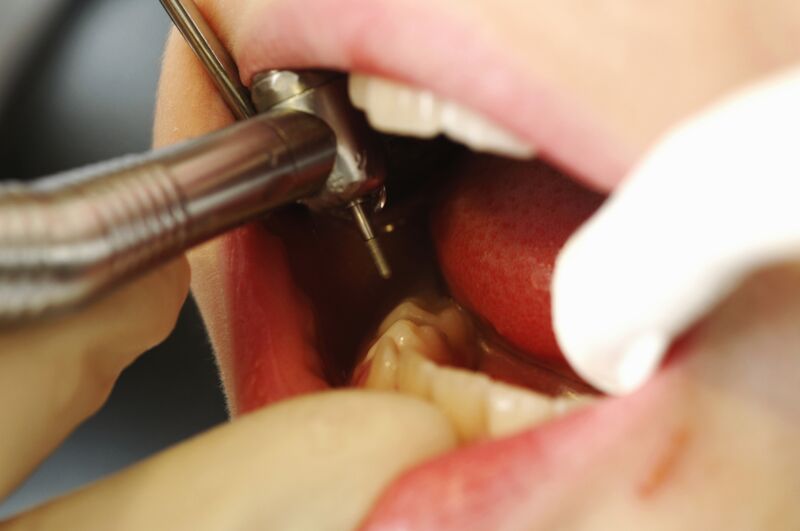 Extreme close-up photograph of dental work being performed on a child's mouth.