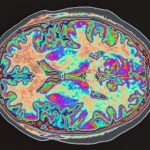 Multicolor image of a brain scan.