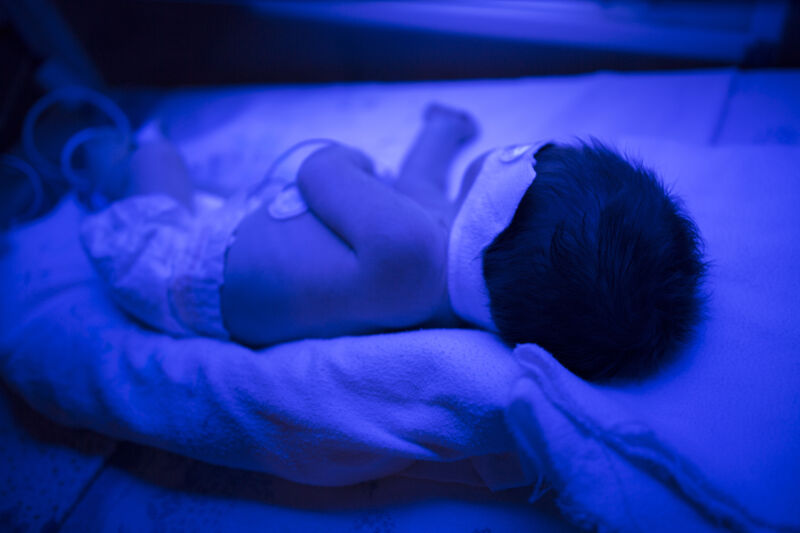A baby being treated with blue light, a jaundice-prevention measure.