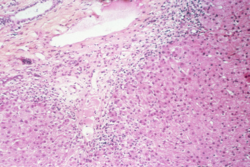 Liver lesions in patient with chronic active hepatitis C.