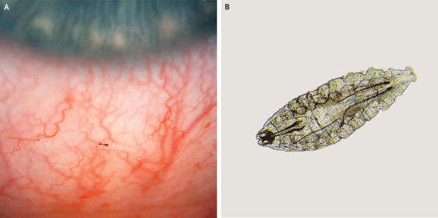 External ophthalmomyiasis (left, showing larvae present in eye) due to <em>Oestrus ovis </em>larvae (right).