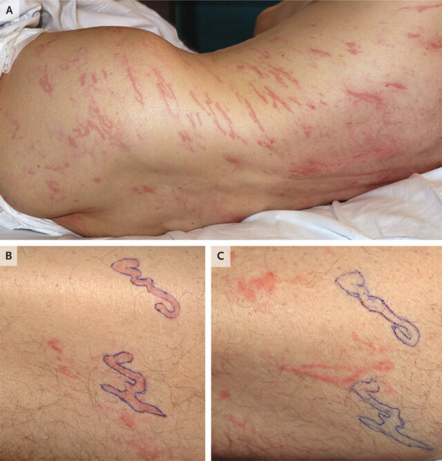 A wavy rash moving on the man's body.  Panels B and C show larval movement over 24 hours.