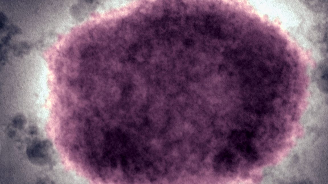 In 2022, the world axed a disease name seen as racist. US just switched back.