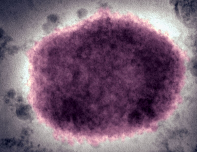 O micrografie electronică cu colorare negativă a unui virion de virus mpox în lichidul vezicular uman. 