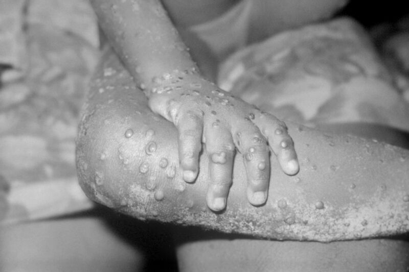 A 2003 photo of the arms and legs of a 4-year-old girl infected with mpox in Liberia. 