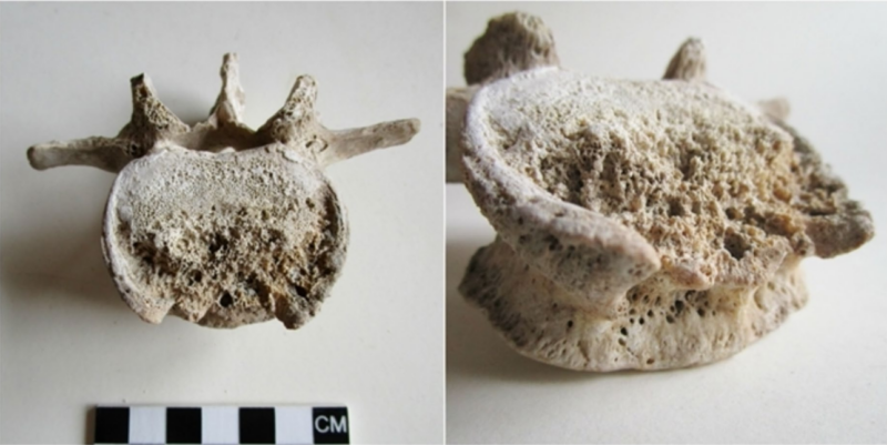 This is not what a healthy lumbar vertebra is supposed to look like. 