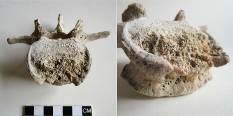 This is not what a healthy lumbar vertebra is supposed to look like.