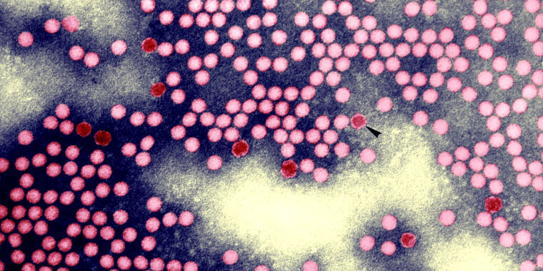 Une infection anormale par une forme éradiquée de poliomyélite montre la ruse du virus