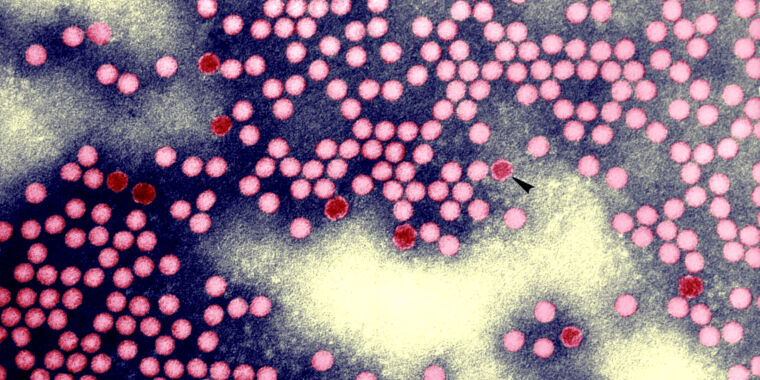 Freak infection with an eradicated form of polio shows virus’ craftiness - Ars Technica