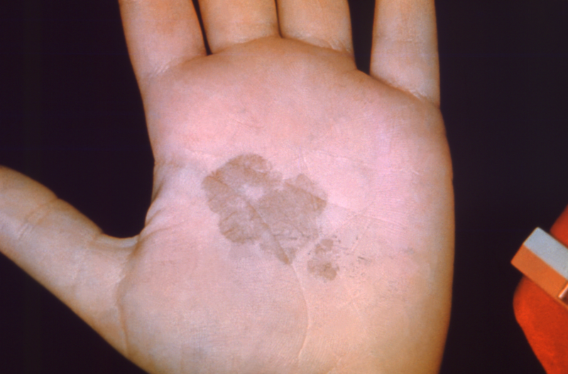 The palm of this patient’s left hand exhibited a brown, discolored, irregularly shaped patch of skin, which had been diagnosed as a case of tinea nigra, caused by the fungus <em>Hortaea werneckii</em>.