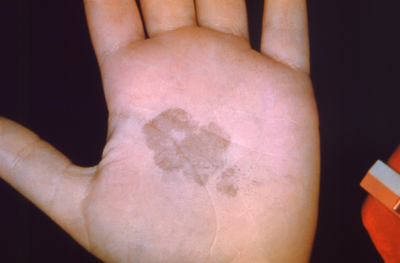 Tinea Nigra: Black Mold Skin Infection (Dematiaceous Pigmented Fungus)  5-Minute Pathology Pearls 