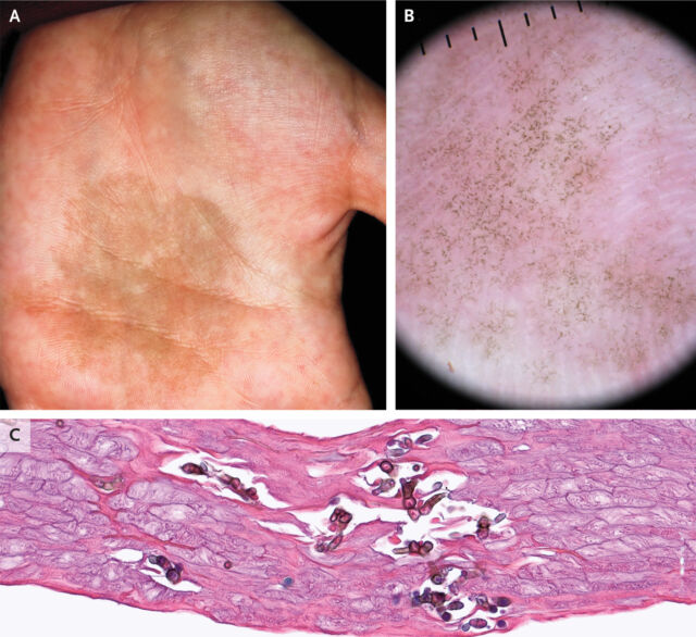 The teen's cases in Philadelphia. Panel A shows the tinea nigra, with a close-up in panel B and pigmented yeast and hyphae seen in a skin sample in panel C.