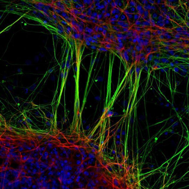 Jianqun Gao and Glenda Halliday, University of Sydney, Australia: "Human neurons derived from neural stem cells." 