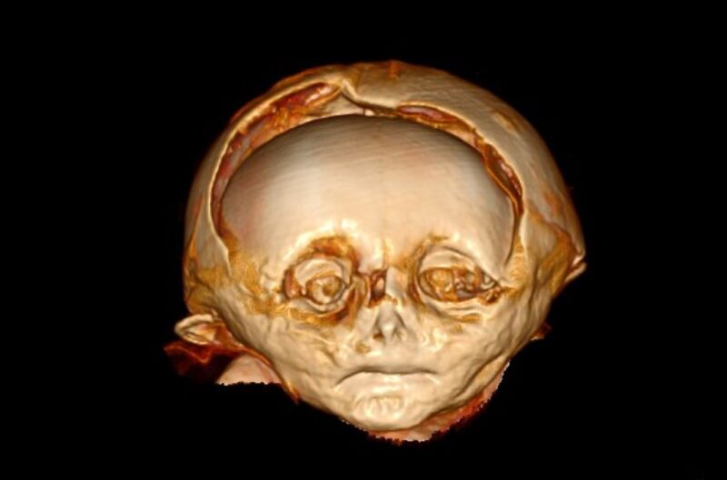 A CT scan of the infant mummy's head, showing deformation of the skull bones.