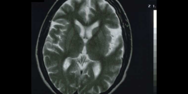 FDA approves new Alzheimer’s treatment despite risks, unclear benefits