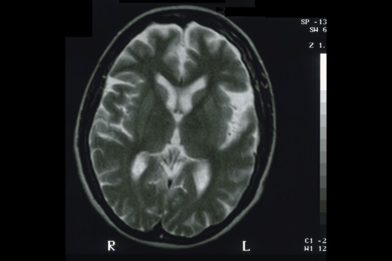 MRI of a human brain.