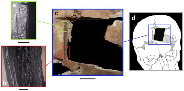 A-B: Magnified edges of the trepanation. C: All four edges of the trepanation. D: Reconstructed location of trepanation on head.