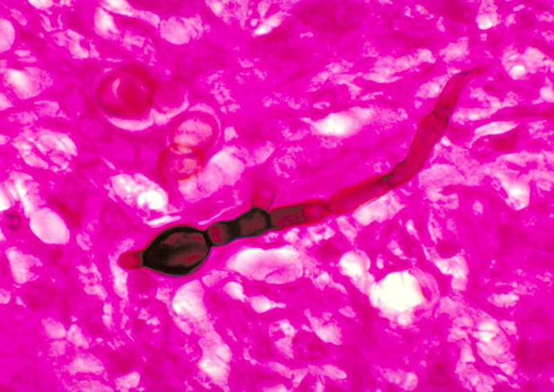This micrograph shows the presence of the fungal agent <em>Blastomyces dermatitidis</em>, 1978. 