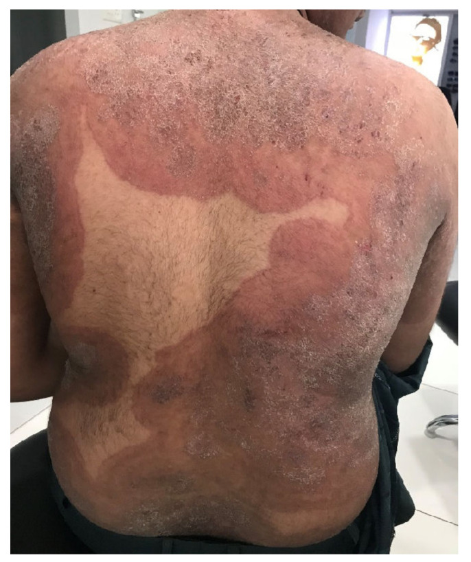 A <em>Trichophyton indotineae</em> infection on the back of an Indian man.
