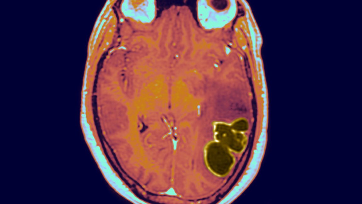 Dangerous brain abscesses spiked in US kids as COVID restrictions ...