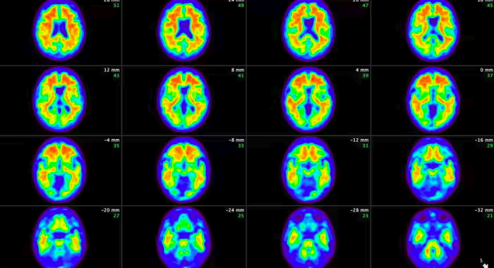 Eli Lilly drug shown to slow Alzheimer’s progression