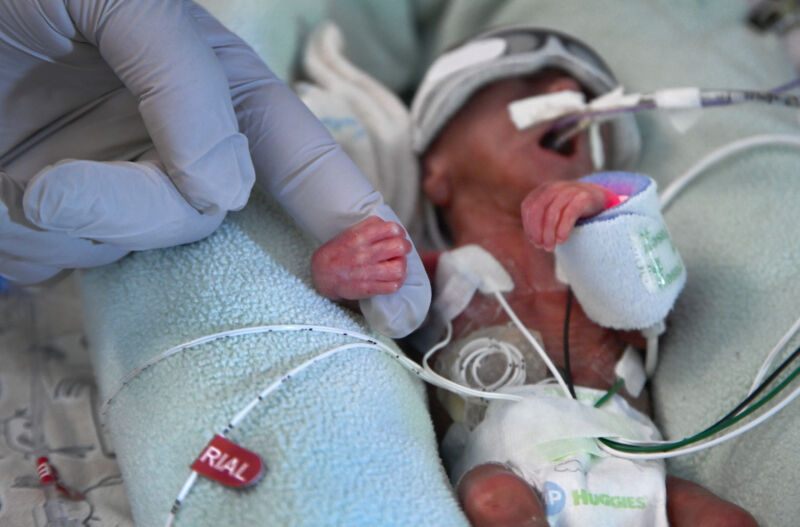 A premature baby in the neonatal intensive care unit at University of Iowa Stead Family Children's Hospital in Iowa City, Iowa on August 13, 2021. The baby was born two days earlier at 22 weeks and at birth weighed just 1 lb., 0.1 oz.  