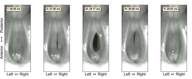 Cinco fotogramas HSV que documentan la apertura y el cierre de la glotis a 6000 fps.