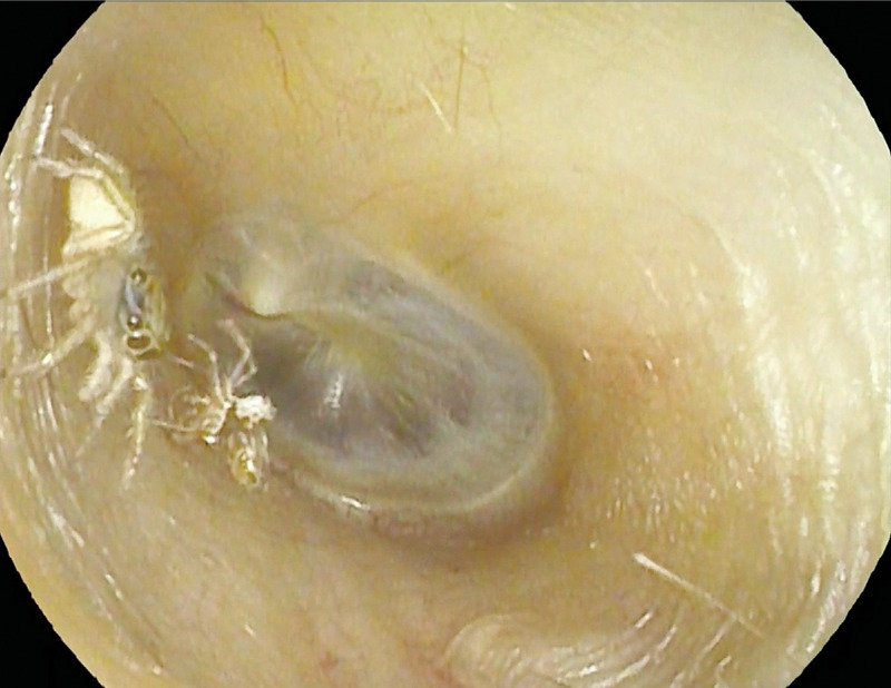 The side view of the spider (on the left) in the ear canal with the exoskeleton in the background.