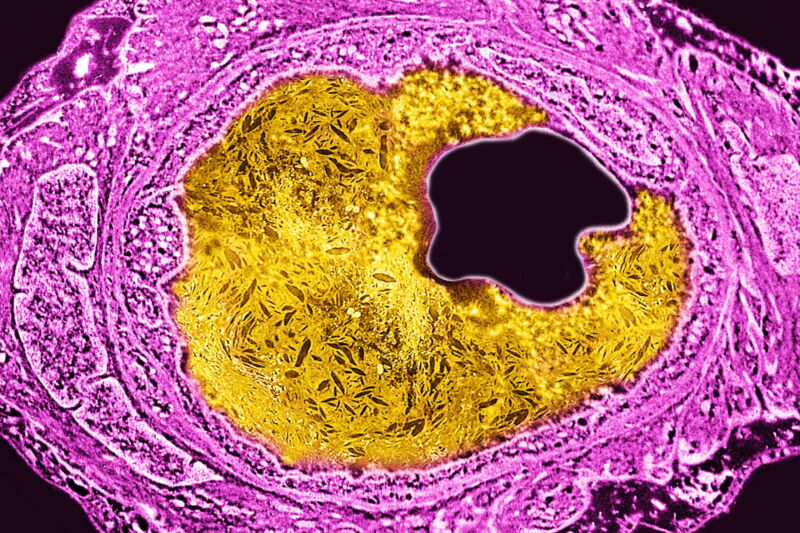 Histological section of an artery suffering from atherosclerosis