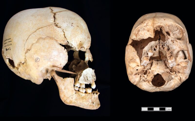 El cráneo de un individuo con síndrome de Turner en mosaico de la Edad del Hierro en Somerset, Reino Unido.