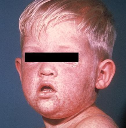measles-437x528.jpeg