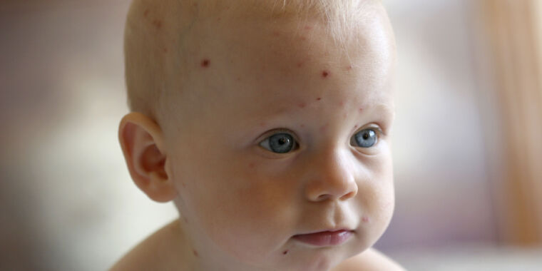 More than half of chickenpox diagnoses are wrong, study finds