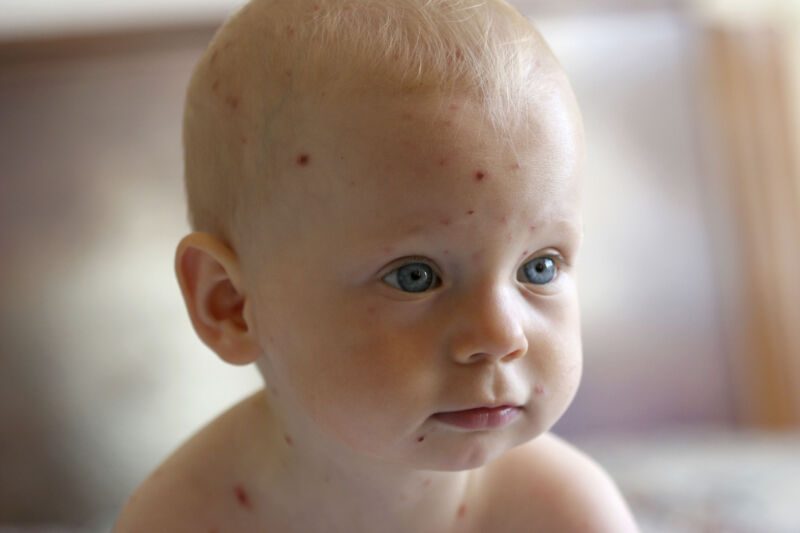 Chickenpox on a 1-year-old.