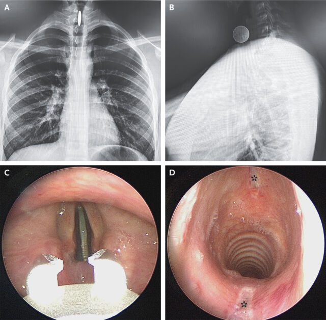   Radiografías de tórax (Panel A, vista posteroanterior) y cuello (Panel B, vista lateral).  Extracción con pinzas ópticas (Panel C y Video 1) y reinspección de la ulceración (Panel D, asteriscos)