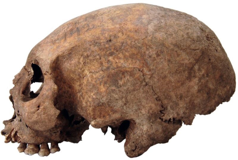 Artificially modified skull from the female Viking individual in Havor, Hablingbo parish, Gotland.