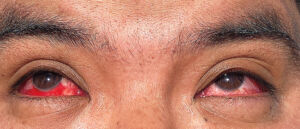 Conjunctivitis with subconjunctival hemorrhage in both eyes of man infected with H5N1.