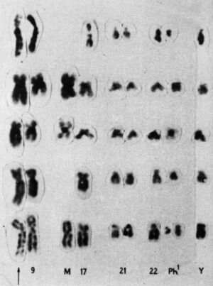 A 1973 Lowry partial karyotype shows a 9;22 translocation.