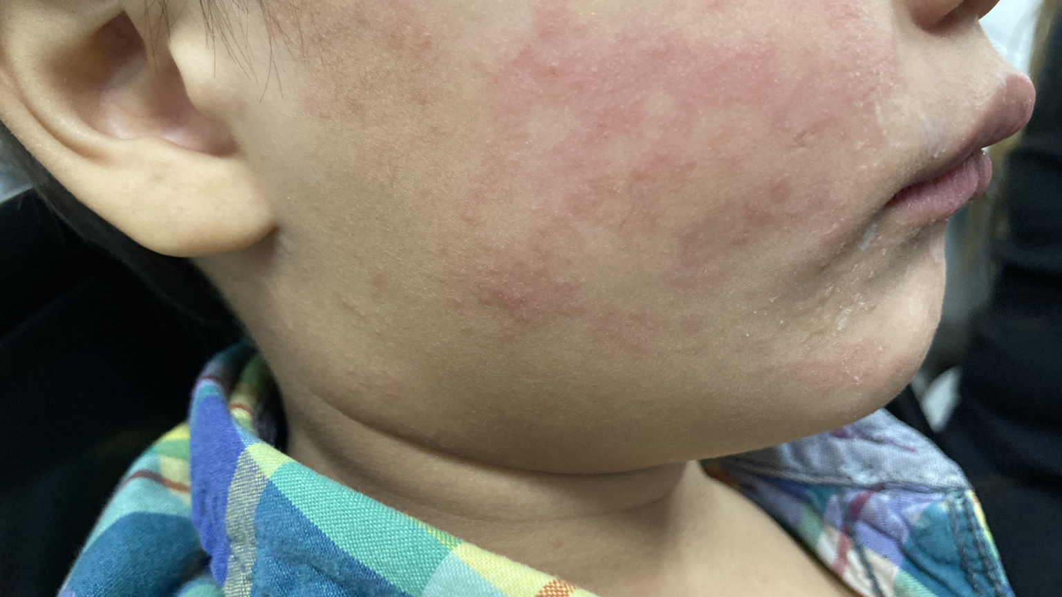 Characteristic Rash Mor Measles continues raging in South Carolina; 99 new cases since Tuesday ...