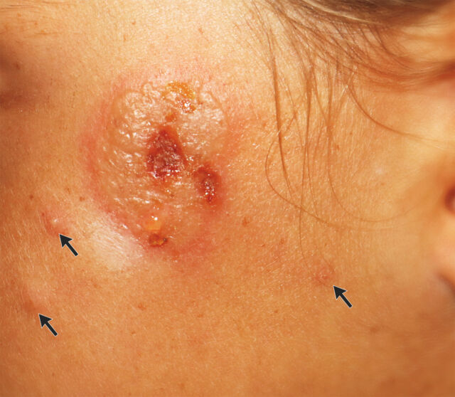 The lesion on the girl's cheek with satellite blisters noted by arrows.