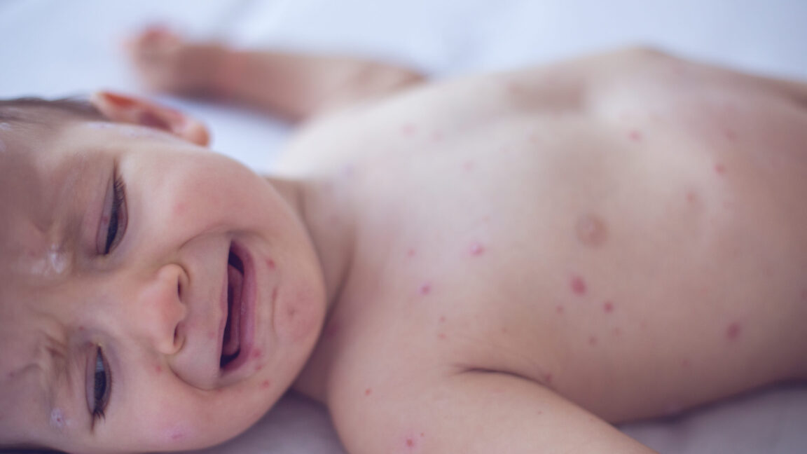 US measles outlook is so bad health experts call for updating vaccine guidance