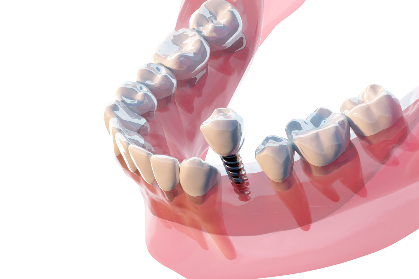 A new dental scam is to pull healthy teeth to sell you expensive fake ...