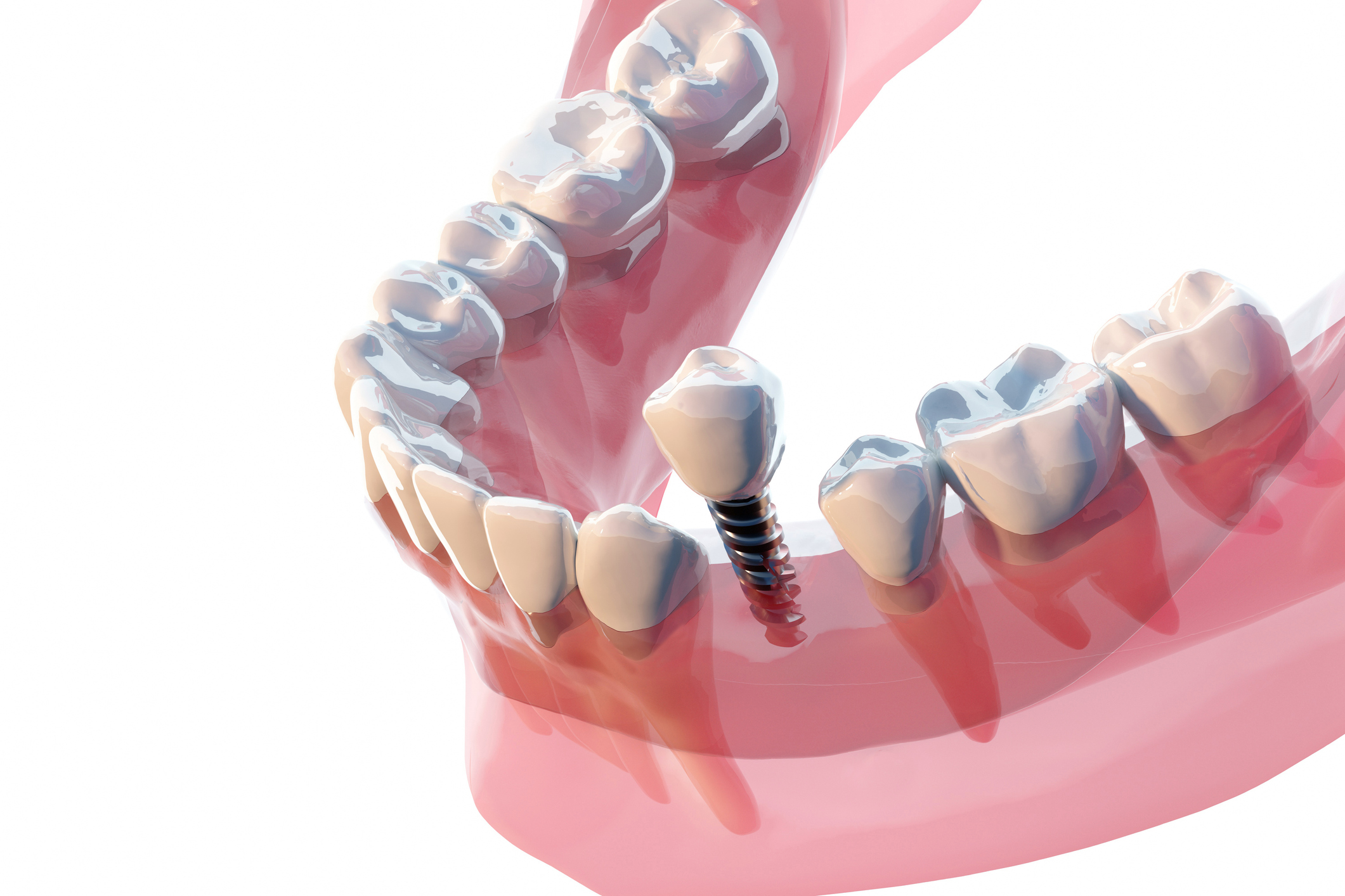 A new dental scam is to pull healthy teeth to sell you expensive fake ones Ars Technica