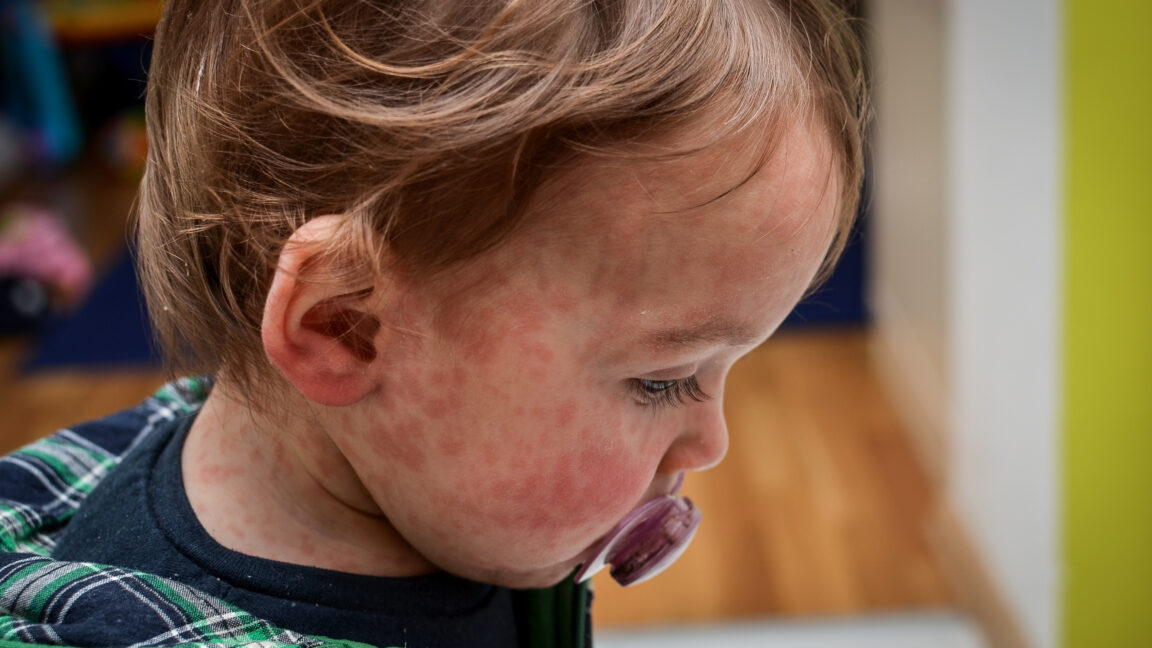 An outbreak of measles in one of Texas' least vaccinated counties continues to rapidly expand, with officials reporting 24 cases Tuesday, up from just